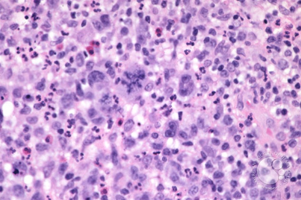 Anaplastic Large Cell Lymphoma - 11.