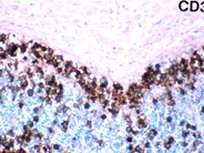 Anaplastic Large Cell Lymphoma - 2.