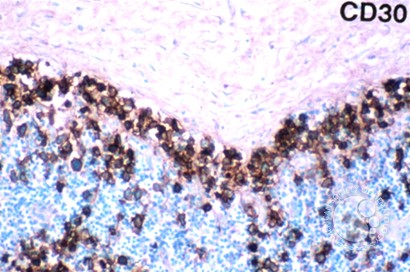 Anaplastic Large Cell Lymphoma - 2.