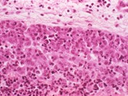 Anaplastic Large Cell Lymphoma - 3.