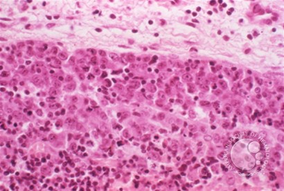 Anaplastic Large Cell Lymphoma - 3.