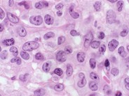Anaplastic Large Cell Lymphoma - 4.