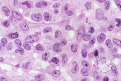 Anaplastic Large Cell Lymphoma - 4.