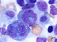 Anaplastic large cell lymphoma