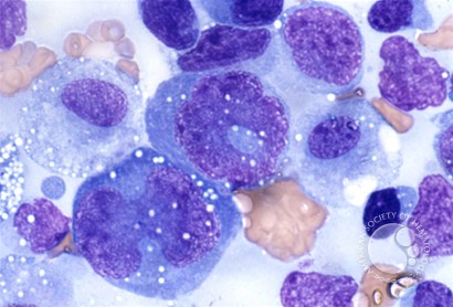 Anaplastic Large Cell Lymphoma - 5.