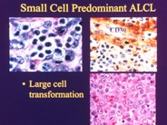 Anaplastic Large Cell Lymphoma - 7.