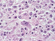 Anaplastic Large Cell Lymphoma - 8.