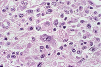 Anaplastic Large Cell Lymphoma - 8.