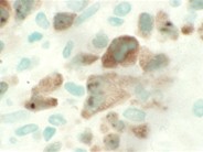 Anaplastic Large Cell Lymphoma - 9.