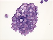 Neuroblastoma - pleural fluid - 1.
