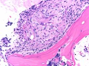 Bone marrow sarcoidosis - 1