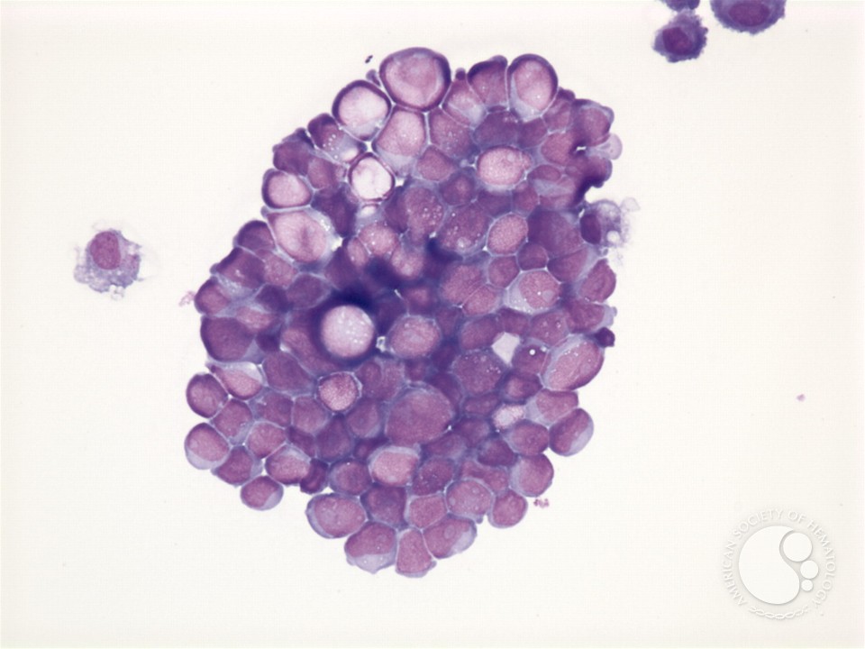 Neuroblastoma - pleural fluid - 1.