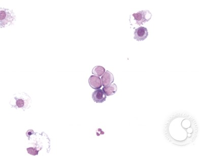 Neuroblastoma - pleural fluid - 2.