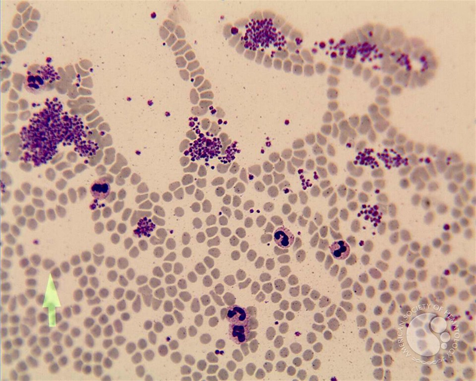 platelet clump in peripheral blood smear