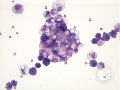 Neuroblastoma - pleural fluid - 3.