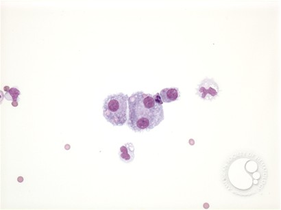 Neuroblastoma - pleural fluid - 4.