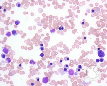 Erythroblastosis Fetails - 1.