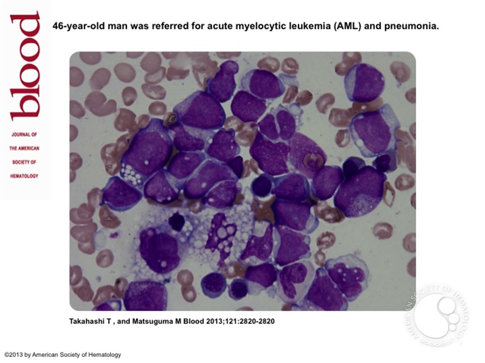 Refractory hemophagocytic syndrome in a patient with acute myelocytic leukemia