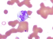 Fungal Inclusions in WBCs - 1.
