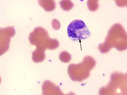 Fungal Inclusions in WBCs - 2.