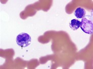 Fungal Inclusions in WBCs - 3.
