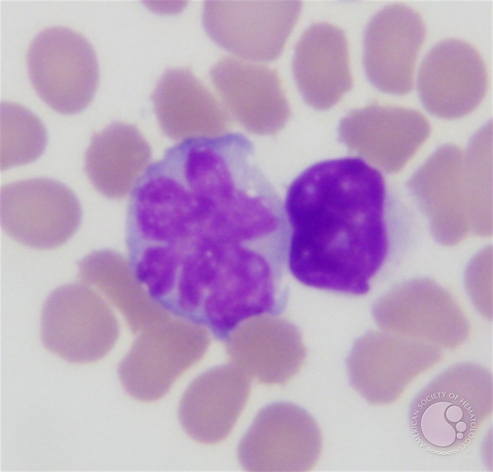 Alk Negative Anaplastic Large Cell Lymphoma Leukemic Phase