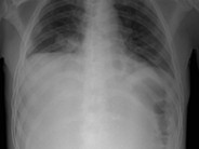 Paraneoplastic hypercalcemia in Diffuse Large B-Cell NHL - 3.