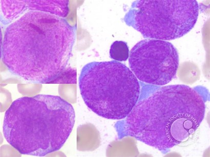 Paediatric acute promyelocytic leukemia with a tetraploid karyotype