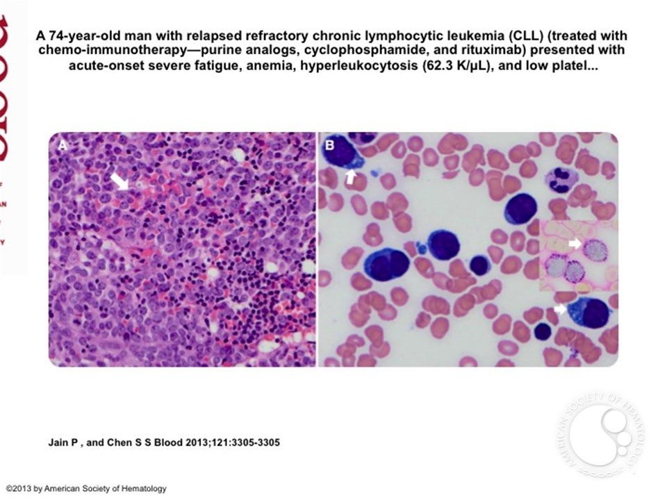 Cytoplasmic globules in erythroid blasts and CLL
