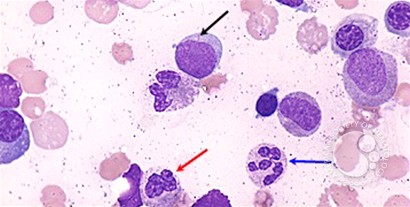 Acute myeloid leukemia with multilineage dysplasia - 1.