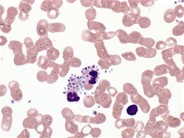 Pseudothrombocytopenia - 2.