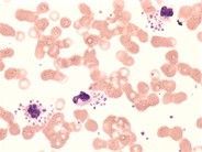 Pseudothrombocytopenia - 4.