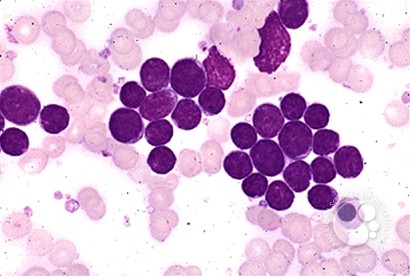 Precusor B-cell Acute Lymphoblastic Leukemia - 2.