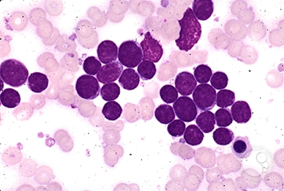 Precusor B-cell Acute Lymphoblastic Leukemia - 2.