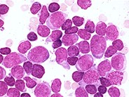 Precusor B-cell Acute Lymphoblastic Leukemia - 3.