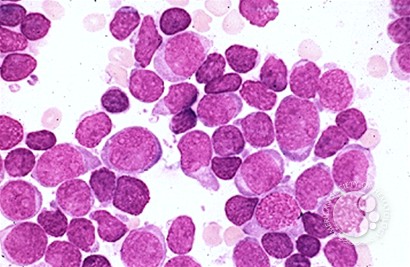 Precusor B-cell Acute Lymphoblastic Leukemia - 3.