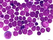 leukemia lymphoblastic acute cell precusor hematology imagebank 1842