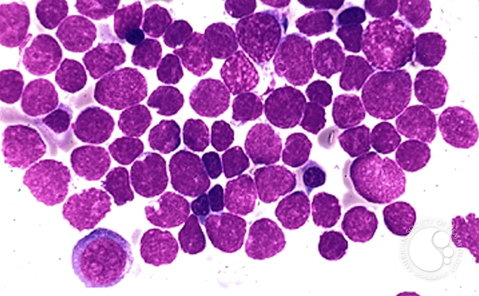 Precusor B-cell Acute Lymphoblastic Leukemia - 4.