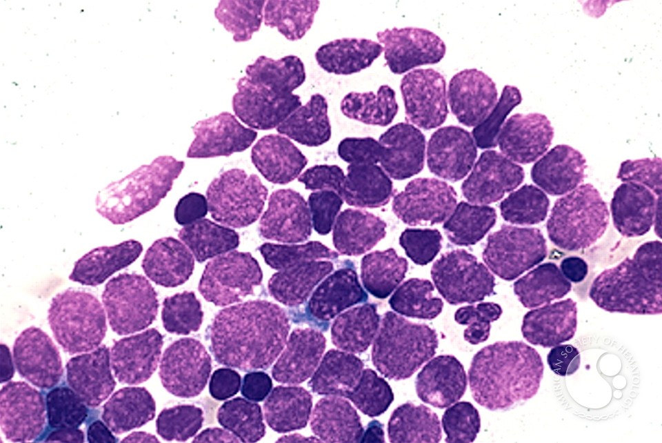Precusor B-cell Acute Lymphoblastic Leukemia - 5.