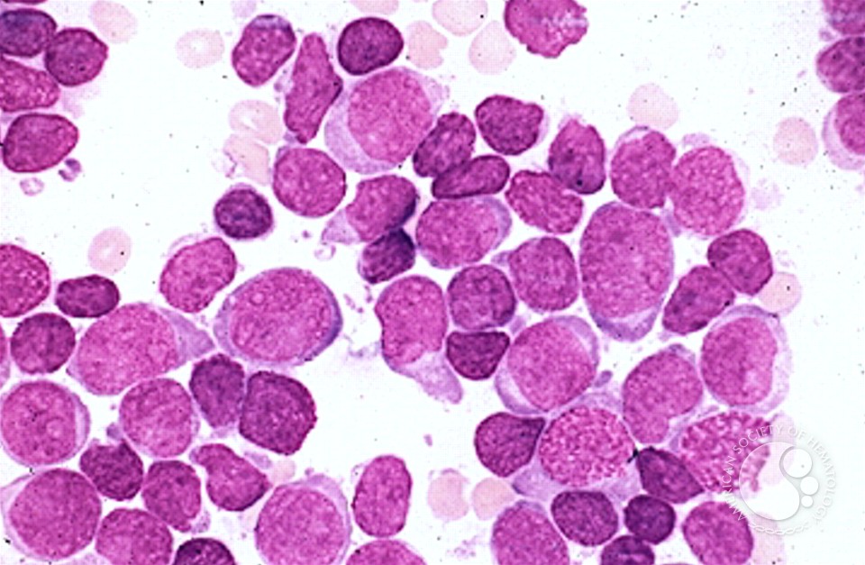Precusor B-cell Acute Lymphoblastic Leukemia - 6.