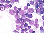 Precusor Bcell Acute Lymphoblastic Leukemia 7.