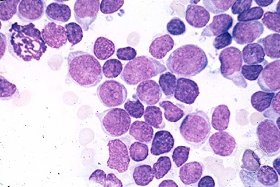 Precusor B-cell Acute Lymphoblastic Leukemia - 7.