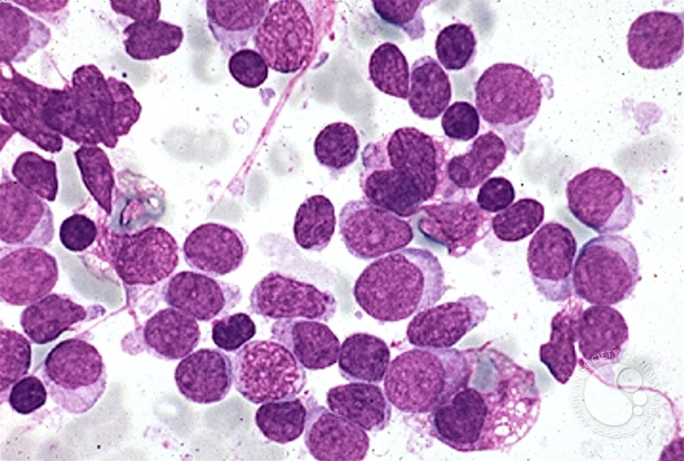 Precusor B-cell Acute Lymphoblastic Leukemia - 8.