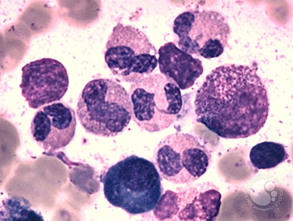 Pseudo Pelger Huet Cells (II) - 1.