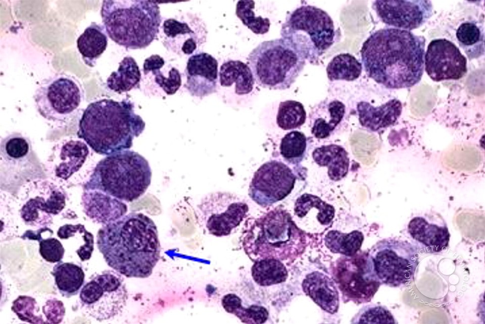 Acute Myeloid Leukemia with inv 16 - 1.