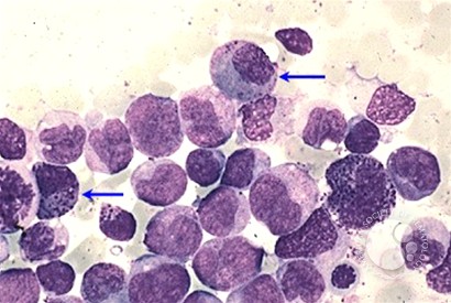 Acute Myeloid Leukemia with inv 16 - 2.