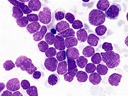 Precursor T-lymphoblastic Leukemia - 1.