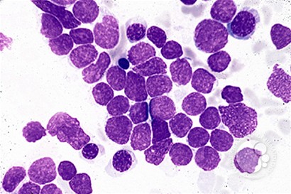 Precursor T-lymphoblastic Leukemia - 1.