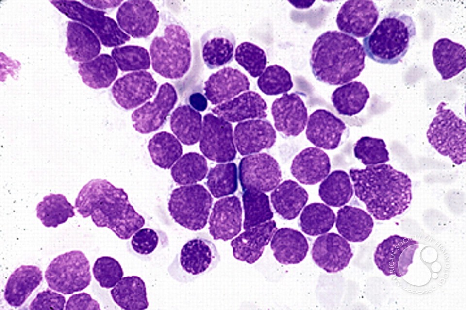 Precursor T-lymphoblastic Leukemia - 1.