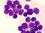 leukemia lymphoblastic precursor